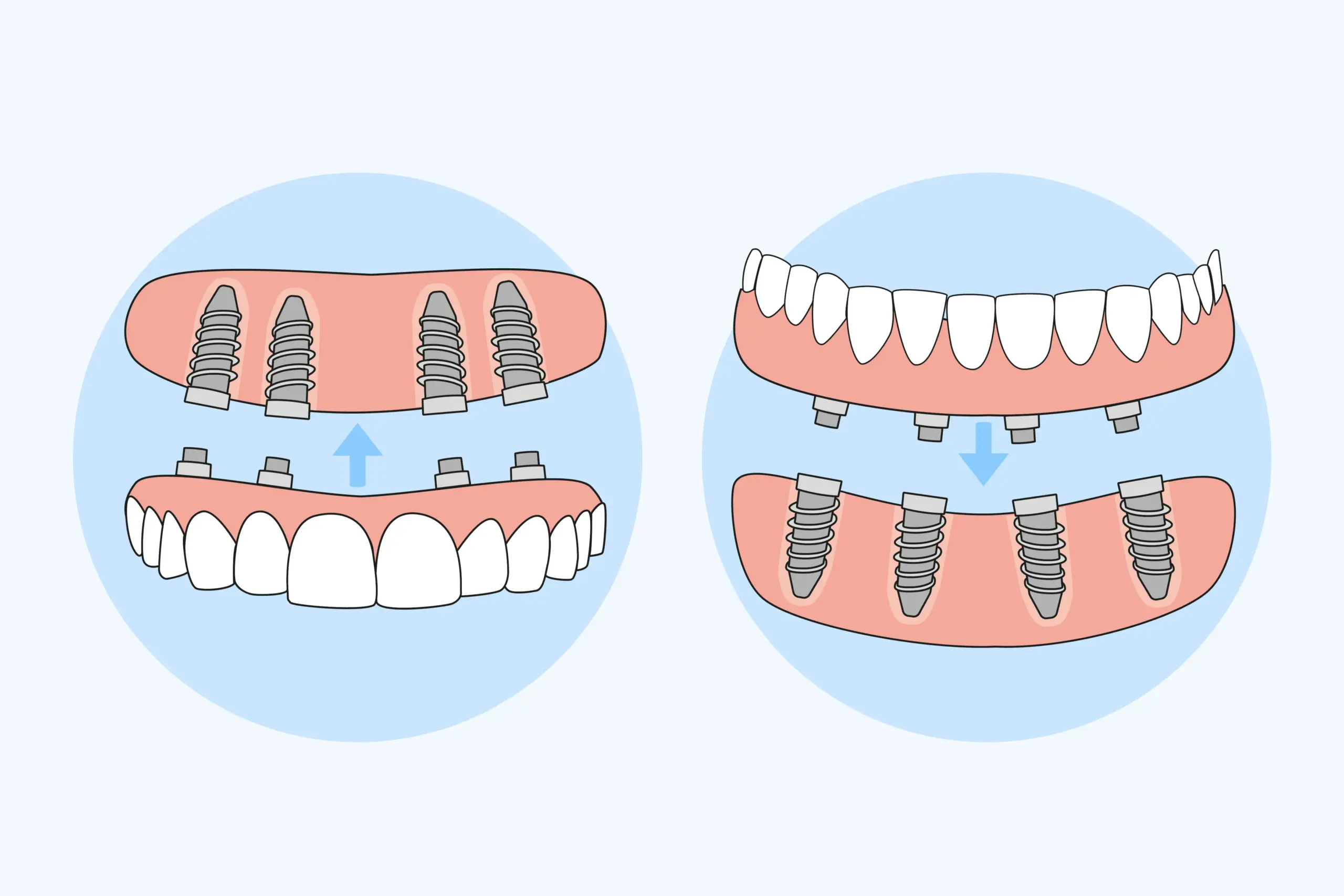 All-on-4 in Bonita Springs, FL. Dr. Juan M. Teodoro, D.M.D. Welcome To Bonita Periodontics & Implants