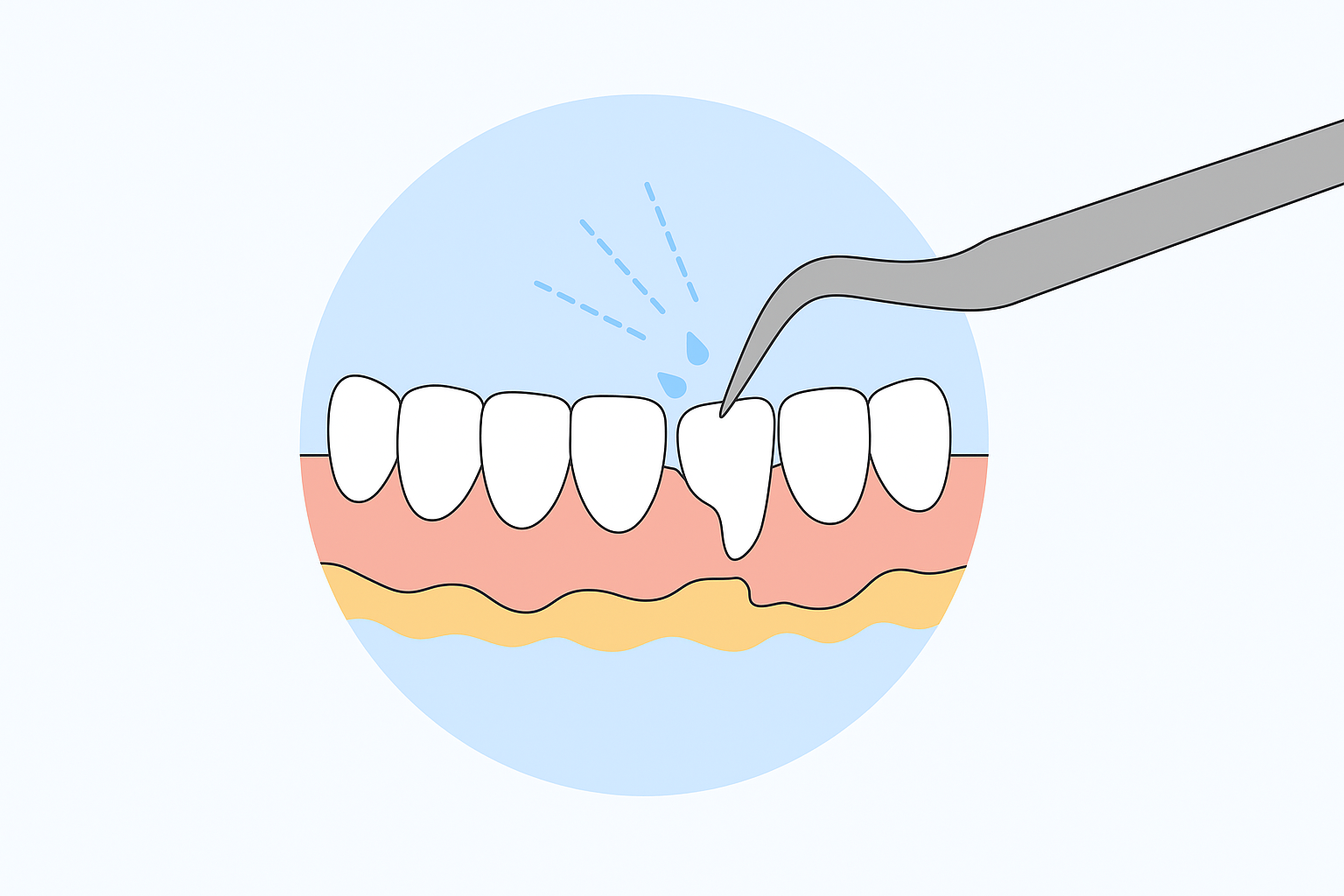 Deep Cleaning in Bonita Springs, FL. Dr. Juan M. Teodoro, D.M.D. Welcome To Bonita Periodontics & Implants