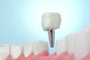 dental implant aftercare